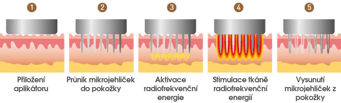 Mikrojehličková radiofrekvence
